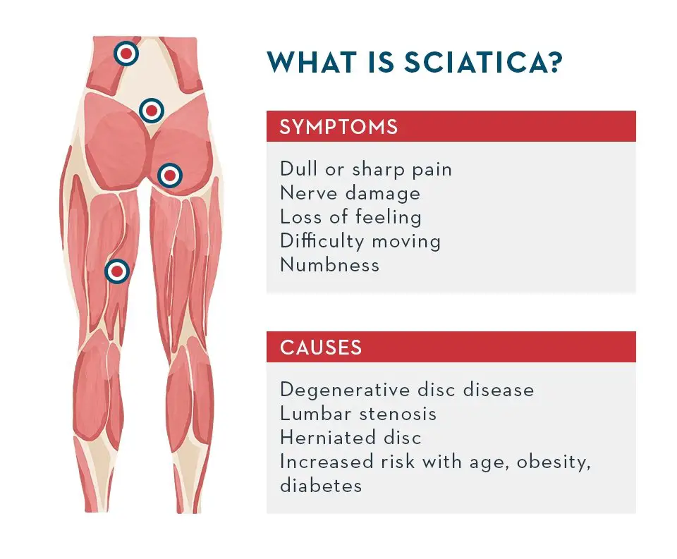 What is sciatica and how to deal with common causes of leg ...